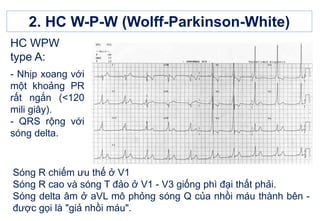 2. HC W-P-W (Wolff-Parkinson-White)
Sóng R chiếm ưu thế ở V1
Sóng R cao và sóng T đảo ở V1 - V3 giống phì đại thất phải.
Sóng delta âm ở aVL mô phỏng sóng Q của nhồi máu thành bên -
được gọi là "giả nhồi máu".
HC WPW
type A:
- Nhịp xoang với
một khoảng PR
rất ngắn (<120
mili giây).
- QRS rộng với
sóng delta.
 
