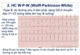 2. HC W-P-W (Wolff-Parkinson-White)
Sóng R cao và sóng T đảo ngược ở các chuyển đạo dưới và V4 - 6
(tương tự phì đại thất trái).
-Nhịp xoang
với PR ngắn
(< 120 ms).
-QRS rộng với
sóng delta.
-Sóng S trội ở
V1.
•Type B: do đường phụ ở bên phải, dạng QS ở chuyển
đạo V1-V3 (sóng delta âm hay đi xuống)
 