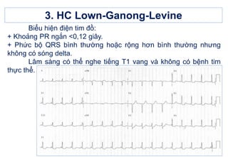 3. HC Lown-Ganong-Levine
Biểu hiện điện tim đồ:
+ Khoảng PR ngắn <0,12 giây.
+ Phức bộ QRS bình thường hoặc rộng hơn bình thường nhưng
không có sóng delta.
Lâm sàng có thể nghe tiếng T1 vang và không có bệnh tim
thực thể.
 