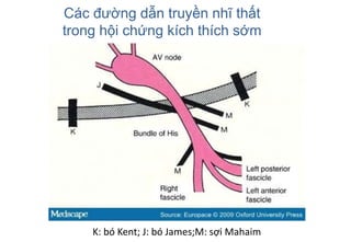 Các đường dẫn truyền nhĩ thất
trong hội chứng kích thích sớm
K: bó Kent; J: bó James;M: sợi Mahaim
 