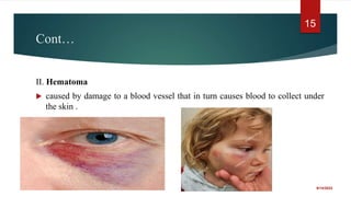 Cont…
II. Hematoma
 caused by damage to a blood vessel that in turn causes blood to collect under
the skin .
9/14/2022
15
 