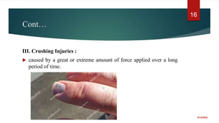 Cont…
III. Crushing Injuries :
 caused by a great or extreme amount of force applied over a long
period of time.
9/14/2022
16
 