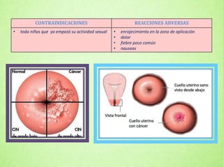 CONTRAINDICACIONES REACCIONES ADVERSAS
• toda niñas que ya empezó su actividad sexual • enrojecimiento en la zona de aplicación
• dolor
• fiebre poco común
• nauseas
 