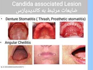 • Median Rhomboidal Glossitis
‫ﻫﺎی‬ ‫ﻋﻔﻮﻧﺖ‬ ‫از‬ ‫ﺷﮑﻠﯽ‬ ●
Chronic atroohic
candidiasis
.‫اﺳﺖ‬
‫ﺣﺪودا‬ ●
2/3
. ‫ﻣﯿﺎﯾﺪ‬ ‫ﺑﻮﺟ...