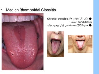 Denture Stomatitis ( Thrash, Prosthetic stomatitis)
●
‫ﻣﺰﻣﻦ‬ ‫اﺗﺮوﻓﯿﮏ‬ ‫ﮐﺎﻧﺪﯾﺪﯾﺎز‬ ‫از‬ ‫ﺷﮑﻠﯽ‬
Chronic atrophic candidiasi...