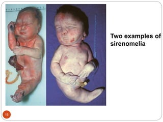 Two examples of
sirenomelia
16
 