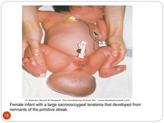Female infant with a large sacrococcygeal teratoma that developed from
remnants of the primitive streak.
18
 
