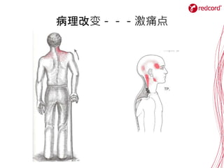病理改变－－－激痛点
 
