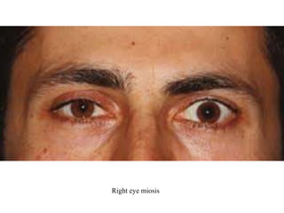 Right eye miosis
 