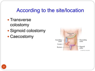 According to the site/location
 Transverse
colostomy
 Sigmoid colostomy
 Caecostomy
21
 