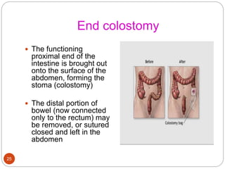 End colostomy
 The functioning
proximal end of the
intestine is brought out
onto the surface of the
abdomen, forming the
stoma (colostomy)
 The distal portion of
bowel (now connected
only to the rectum) may
be removed, or sutured
closed and left in the
abdomen
25
 