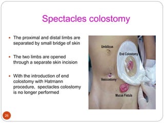 Spectacles colostomy
 The proximal and distal limbs are
separated by small bridge of skin
 The two limbs are opened
through a separate skin incision
 With the introduction of end
colostomy with Hatmann
procedure, spectacles colostomy
is no longer performed
26
 