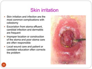 Skin irritation
 Skin irritation and infection are the
most common complications with
colostomy
 Excoriation from stoma effluent,
candidal infection and dermatitis
are frequent
 Improper location or construction
of the stoma and poor stoma care
are often responsible
 Local wound care and patient or
caretaker education often corrects
the problem
55
 