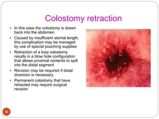 Colostomy retraction
 In this case the colostomy is drawn
back into the abdomen
 Caused by insufficient stomal length,
this complication may be managed
by use of special pouching supplies
 Retraction of a loop colostomy
results in a blow hole configuration
that allows proximal contents to spill
into the distal segment
 Revision may be required if distal
diversion is necessary
 Permanent colostomy that have
retracted may require surgical
revision
59
 