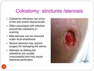 Colostomy strictures /stenosis
 Colostomy strictures can occur
at the skin and/or fascial levels
 Often associated with infection
around the colostomy or
scarring
 Mild stenosis can be removed
under local anesthesia
 Severe stenosis may require
surgery for reshaping the stoma
 Attempts at dilating the
colostomy are usually
unsuccessful and may cause
intestinal perforation
60
 
