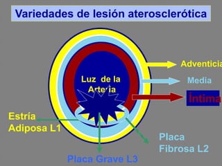 Luz de la
Arteria
Íntima
Media
Adventicia
Estría
Adiposa L1
Placa
Fibrosa L2
Placa Grave L3
Variedades de lesión ateroscle...