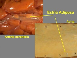 Estría Adiposa
Arteria coronaria
Aorta
 