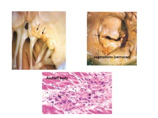Aschoff body
vegetations (verrucae)
 