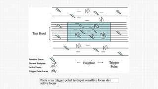 Pada area trigger point terdapat sensitive locus dan
active locus
 