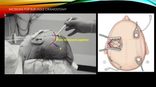 línea temporal superior
F
P
INCISIONS FOR BUR-HOLE CRANIOSTOMY
 