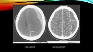 HSD AGUDO HSD SUBAGUDO
 