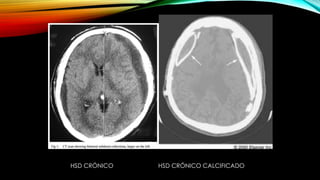HSD CRÓNICO HSD CRÓNICO CALCIFICADO
 