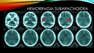 HEMORRAGIA SUBARACNOIDEA
TRAUMÁTICA
 