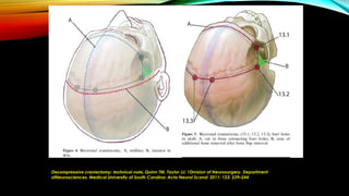 Decompressive craniectomy: technical note, Quinn TM, Taylor JJ; 1Division of Neurosurgery, Department
ofNeurosciences, Medical University of South Carolina; Acta Neurol Scand: 2011: 123: 239–244
 