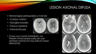 • Hemorragias petequiales a nivel de
• –Cuerpo calloso
• –Ganglios basales
• –Tronco cerebral
• –Intraventricular
• Cursa con coma inmediato –La
Presión intracraneal suele ser casi
siempre normal (no hay efecto masa
relevante)
LESION AXONAL DIFUSA
 