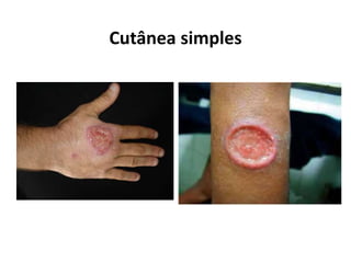 Cutânea simples
 