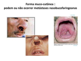 Forma muco-cutânea :
podem ou não ocorrer metástases nasobucofaringeanas
 