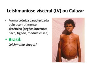 Leishmaniose visceral (LV) ou Calazar
• Forma crônica caracterizada
pelo acometimento
sistêmico (órgãos internos:
baço, fígado, medula óssea)
• Brasil:
Leishmania chagasi
 