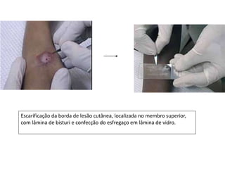 Escarificação da borda de lesão cutânea, localizada no membro superior,
com lâmina de bisturi e confecção do esfregaço em lâmina de vidro.
 