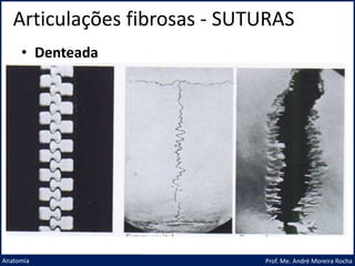 Articulações fibrosas - SUTURAS
Prof. Me. André Moreira Rocha
Anatomia
• Denteada
 
