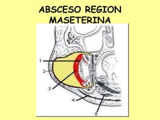 ABSCESO REGION
MASETERINA
 