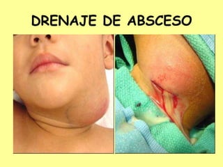 DRENAJE DE ABSCESO
 