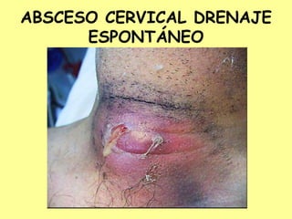 ABSCESO CERVICAL DRENAJE
ESPONTÁNEO
 