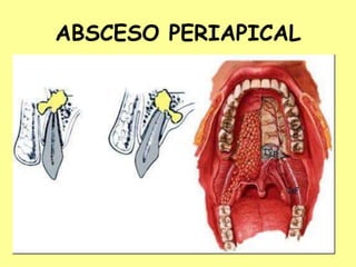 ABSCESO PERIAPICAL
 