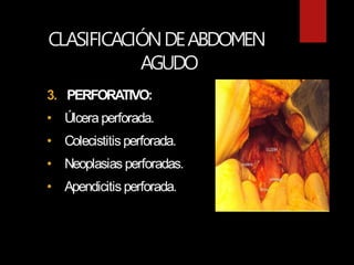 CLASIFICACIÓNDEABDOMEN
AGUDO
3. PERFORATIVO:
• Úlcera perforada.
• Colecistitis perforada.
• Neoplasias perforadas.
• Apendicitis perforada.
 