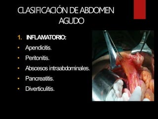 CLASIFICACIÓNDEABDOMEN
AGUDO
1. INFLAMATORIO:
• Apendicitis.
• Peritonitis.
• Abscesos intraabdominales.
• Pancreatitis.
• Diverticulitis.
 