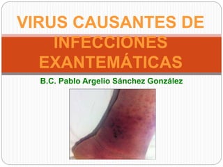 B.C. Pablo Argelio Sánchez González
VIRUS CAUSANTES DE
INFECCIONES
EXANTEMÁTICAS
 