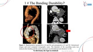 aortic banding | PDF