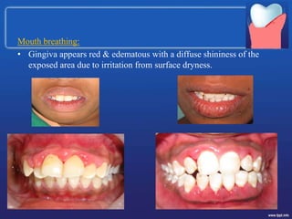 Mouth breathing:
• Gingiva appears red & edematous with a diffuse shininess of the
exposed area due to irritation from surface dryness.
 
