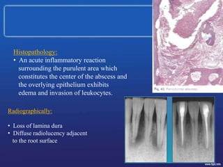 Histopathology:
• An acute inflammatory reaction
surrounding the purulent area which
constitutes the center of the abscess and
the overlying epithelium exhibits
edema and invasion of leukocytes.
Radiographically:
• Loss of lamina dura
• Diffuse radiolucency adjacent
to the root surface
 