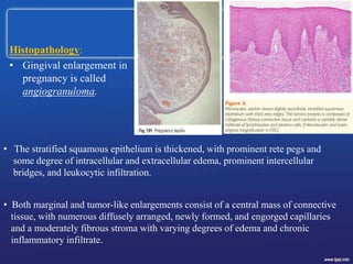 Histopathology:
• Gingival enlargement in
pregnancy is called
angiogranuloma.
• The stratified squamous epithelium is thickened, with prominent rete pegs and
some degree of intracellular and extracellular edema, prominent intercellular
bridges, and leukocytic infiltration.
• Both marginal and tumor-like enlargements consist of a central mass of connective
tissue, with numerous diffusely arranged, newly formed, and engorged capillaries
and a moderately fibrous stroma with varying degrees of edema and chronic
inflammatory infiltrate.
 