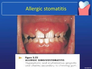 Allergic stomatitis
 