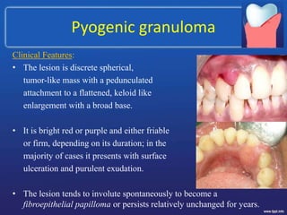 Pyogenic granuloma
Clinical Features:
• The lesion is discrete spherical,
tumor-like mass with a pedunculated
attachment to a flattened, keloid like
enlargement with a broad base.
• It is bright red or purple and either friable
or firm, depending on its duration; in the
majority of cases it presents with surface
ulceration and purulent exudation.
• The lesion tends to involute spontaneously to become a
fibroepithelial papilloma or persists relatively unchanged for years.
 
