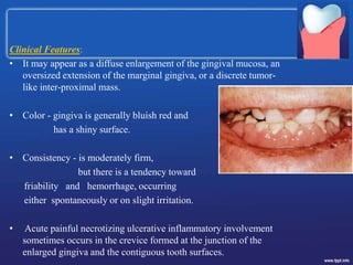 Clinical Features:
• It may appear as a diffuse enlargement of the gingival mucosa, an
oversized extension of the marginal gingiva, or a discrete tumor-
like inter-proximal mass.
• Color - gingiva is generally bluish red and
has a shiny surface.
• Consistency - is moderately firm,
but there is a tendency toward
friability and hemorrhage, occurring
either spontaneously or on slight irritation.
• Acute painful necrotizing ulcerative inflammatory involvement
sometimes occurs in the crevice formed at the junction of the
enlarged gingiva and the contiguous tooth surfaces.
 