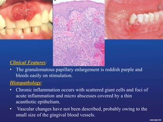Clinical Features:
• The granulomatous papillary enlargement is reddish purple and
bleeds easily on stimulation.
Histopathology:
• Chronic inflammation occurs with scattered giant cells and foci of
acute inflammation and micro abscesses covered by a thin
acanthotic epithelium.
• Vascular changes have not been described, probably owing to the
small size of the gingival blood vessels.
 