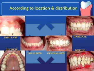 According to location & distribution
GENERALIZED
LOCALIZED
PAPILLARY
DISCRETE DIFFUSE
MARGINAL
 